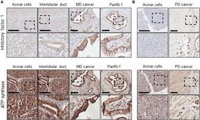 F1F0-ATP Synthase Inhibitory Factor 1 in the Normal Pancreas and in Pancreatic Ductal Adenocarcinoma: Effects on Bioenergetics, Invasion and Proliferation